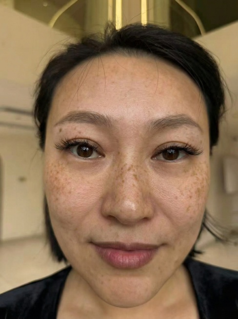 将图片中的面部斑点变得更明显，其他保持原样，不进行磨皮处理预览效果