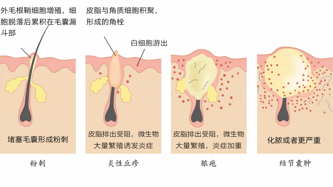 参考原图的医学插画风格，重新生成粉刺发展成结节囊肿的四个阶段皮肤毛囊示意图，保留所有标注文字和结构：第一阶段标注：外毛根鞘细胞增殖，细胞脱落后累积在毛囊漏斗部，堵塞毛囊形成粉刺，标题粉刺；第二阶段标注预览效果