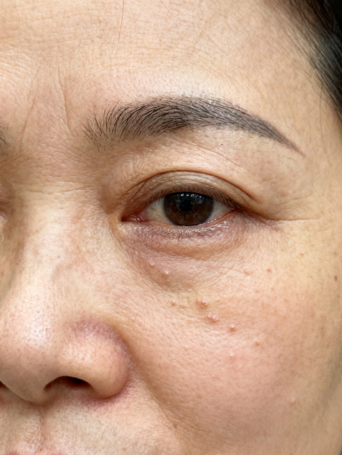 三十五岁左右的女性，露出完整全脸，眼部状态略差，眼下分布有较多明显的脂肪粒，面部真实自然，符合亚洲人面部特征，画质清晰预览效果