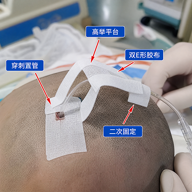 脑室引流管高举平台固定法示意图，展示穿刺置管后双E形胶布高举平台二次固定操作，医用临床实拍，清晰展示管路固定细节，专业医疗风格