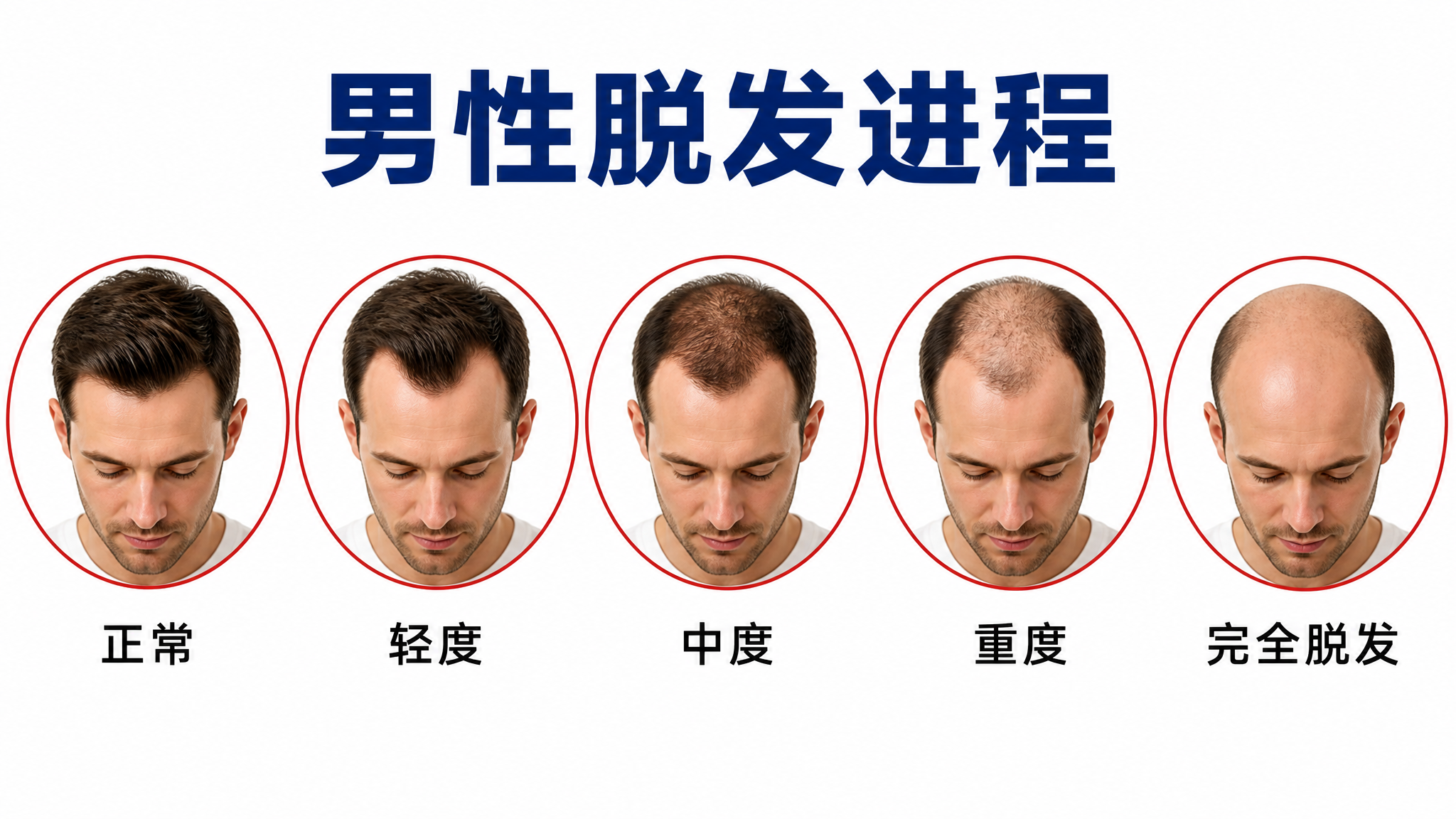 一张白底的男性脱发进程对比图，国际男性（白人男性，30-40岁… - 图片创意预览