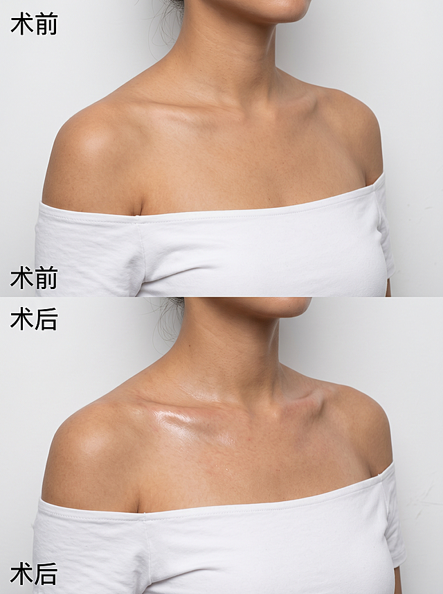 生成一张上下分屏的医美对比图，主体为亚洲女性肩颈至胸部上半部分，面部不出镜。 上半部分为术前：穿着白色抹肩上衣，背景为纯白哑光墙，光线柔和均匀，锁骨扁平无形，皮肤白皙无痕迹，肩颈线条自然。 下半部分为术后：同姿态同服饰同背景，锁骨更立体突出，锁骨上方有轻微泛红有水光痕迹，肩部视觉更单薄，整体光影与术前一致。 风格为真实纪实医美对比照，高清无过度磨皮，生成三张不同肤色体型的案例3:4