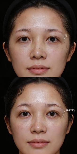 根据这张上下对比的眼部特写，补充生成对应的完整全脸对比照片，上下分别保留对应原图的五官特征、皮肤质感与眼尾提升的效果，人物整体风格协调真实预览效果