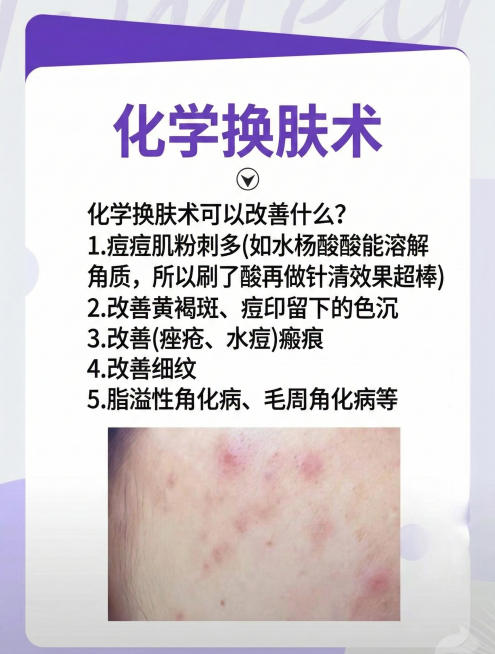 将图片中红蓝光换为化学换肤术。删除“快速战痘，少留痘印”。将“红蓝光是祛痘的常用物理治疗方法，尤其是对炎症期的痤疮痘痘来说效果还是可人的”换为“化学换肤术可以改善什么？
1.痘痘肌粉刺多(如水杨酸酸能预览效果