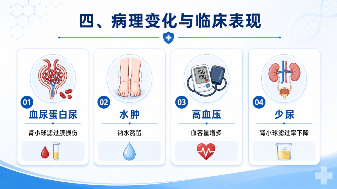 医学PPT页面，标题是"四、病理变化与临床表现"，内容：血尿蛋白尿：肾小球滤过膜损伤；水肿：钠水潴留；高血压：血容量增多；少尿：肾小球滤过率下降，清晰排版医学PPT预览效果