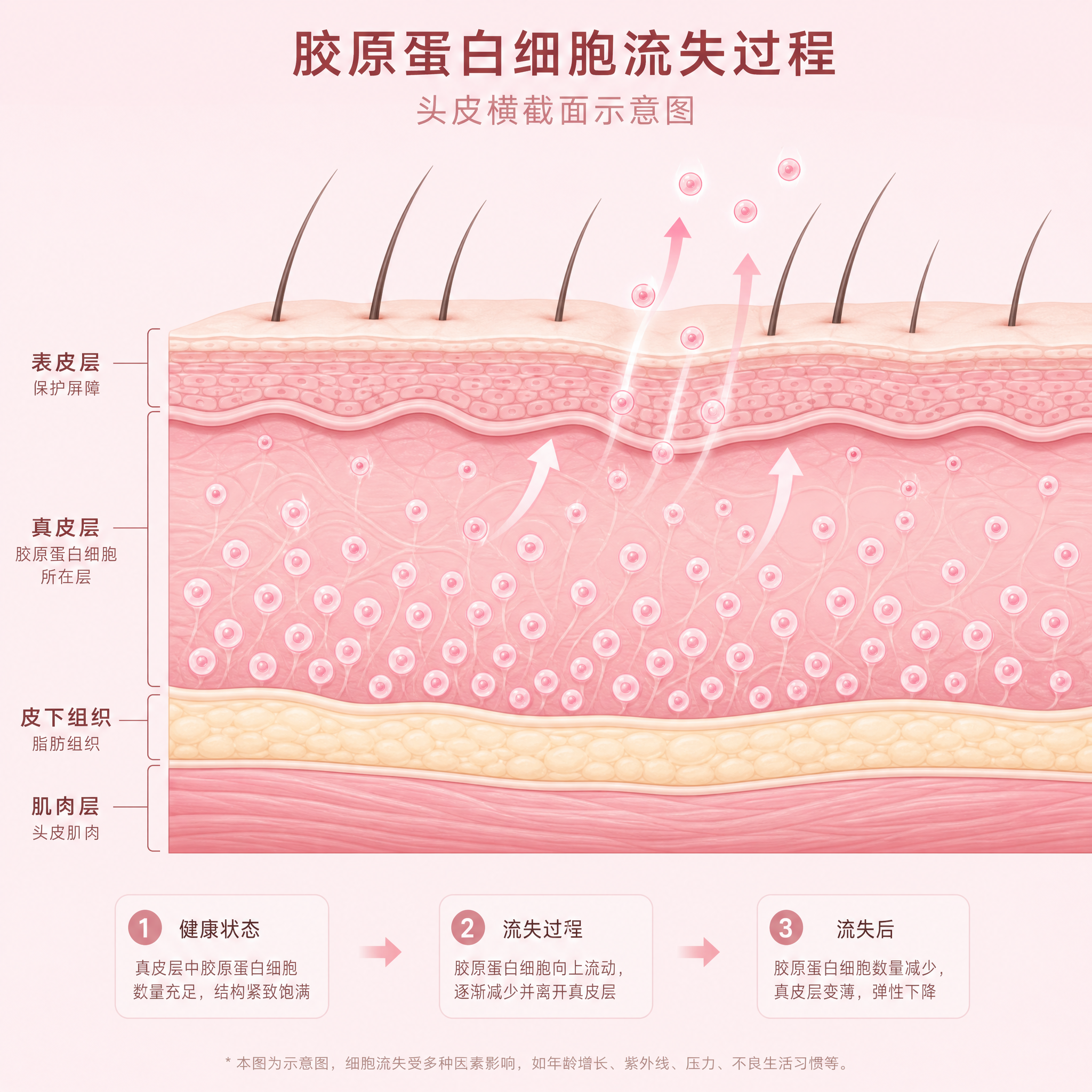 简单医学插画风格，头皮横截面示意图，展示胶原蛋白细胞流失过程。… - 图片创意预览