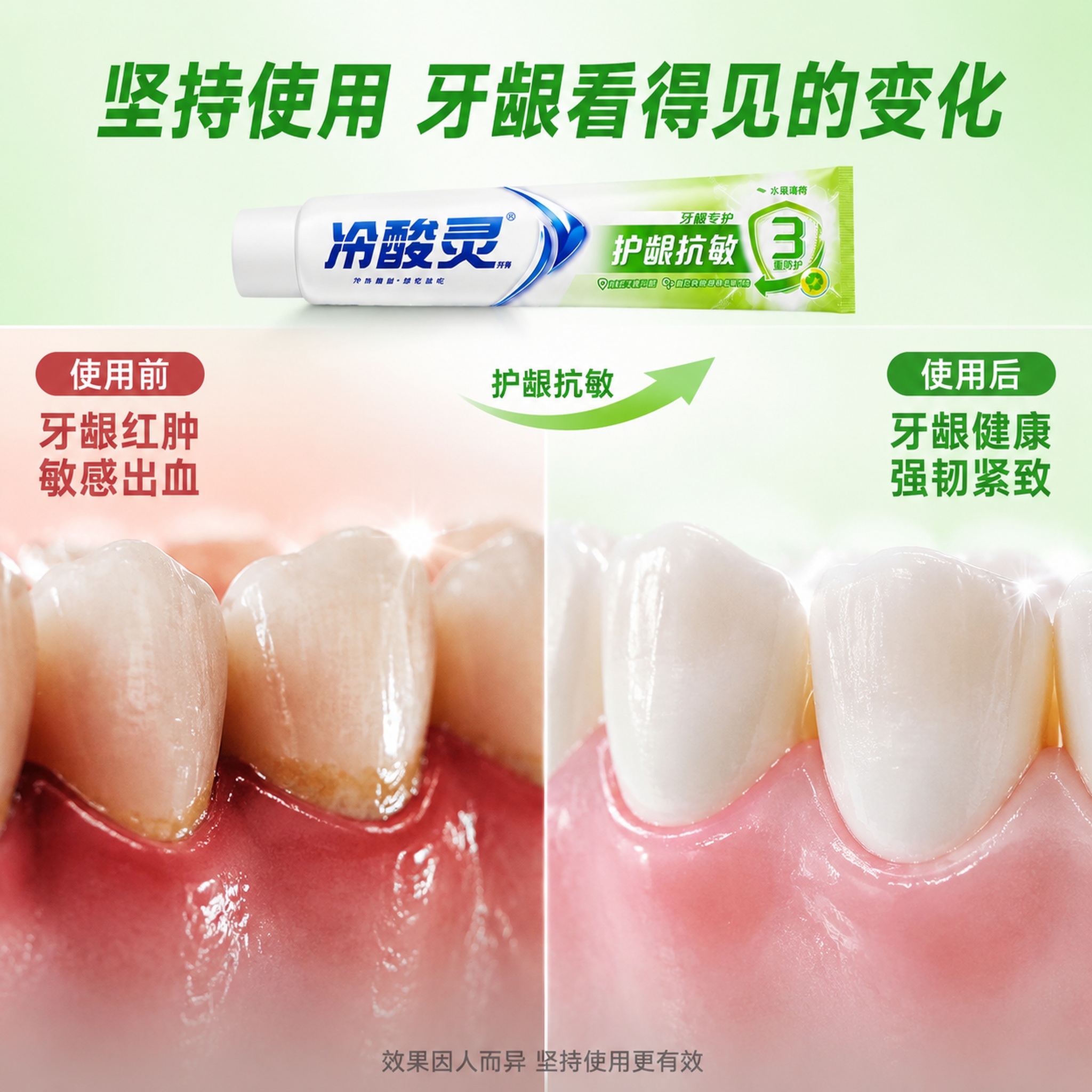 [主图-2] 冷酸灵牙膏牙龈健康对比图，使用前后牙龈状态改善，… - 图片创意预览