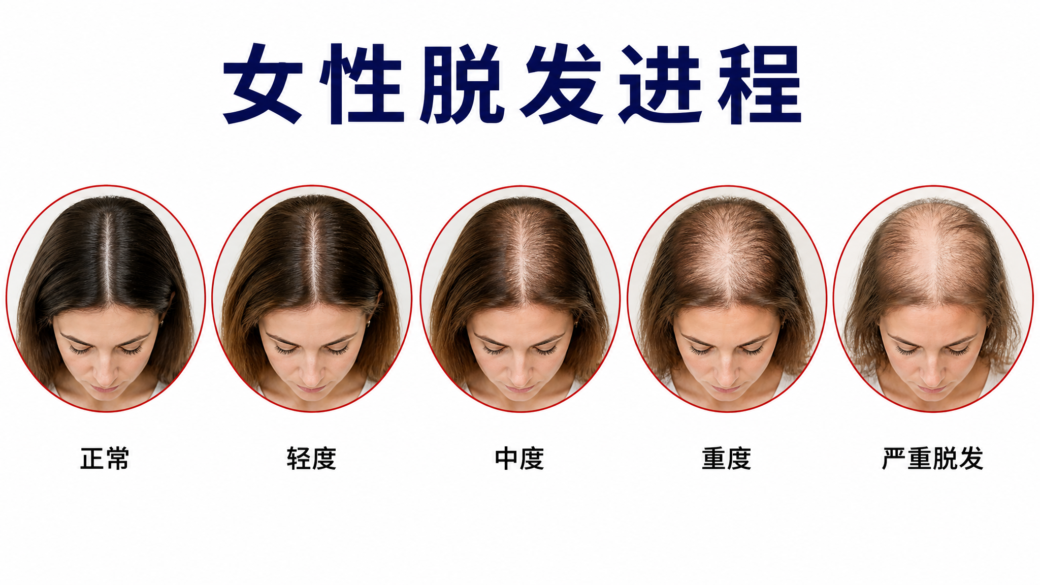 一张白底的女性脱发进程对比图，国际女性（白人女性，30-40岁… - 图片创意预览