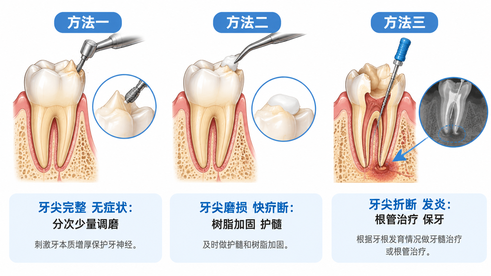 白底医学科普图，横向排列三个方法展示畸形中央尖不同阶段的处理方… - 图片创意预览