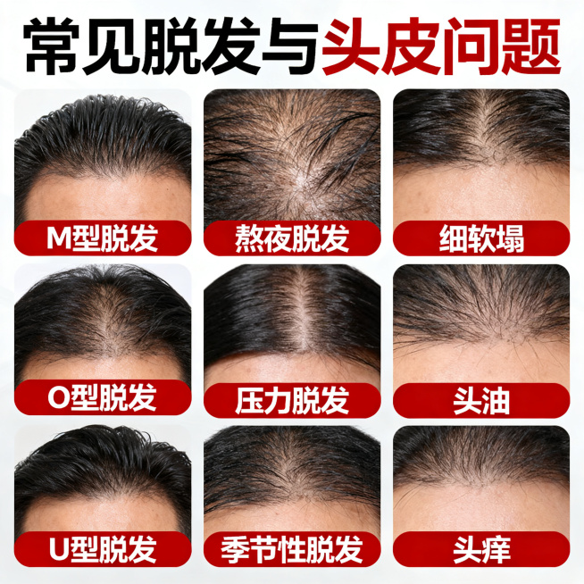 洗发水直播间宣传KT板设计，展示常见脱发和头皮问题，包含：M型脱发、O型脱发、U型脱发、熬夜脱发、压力脱发、季节性脱发、细软塌、头油、头痒，每个问题配对应头皮实景图片，红色标签标注名称，整体风格简洁醒预览效果