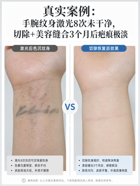 案例对比图，标题：真实案例：手腕纹身激光8次未干净，切除+美容缝合3个月后疤痕极淡，左侧展示激光后色沉纹身，右侧展示切除恢复后效果，对比清晰，医疗科普风，竖版3:4预览效果