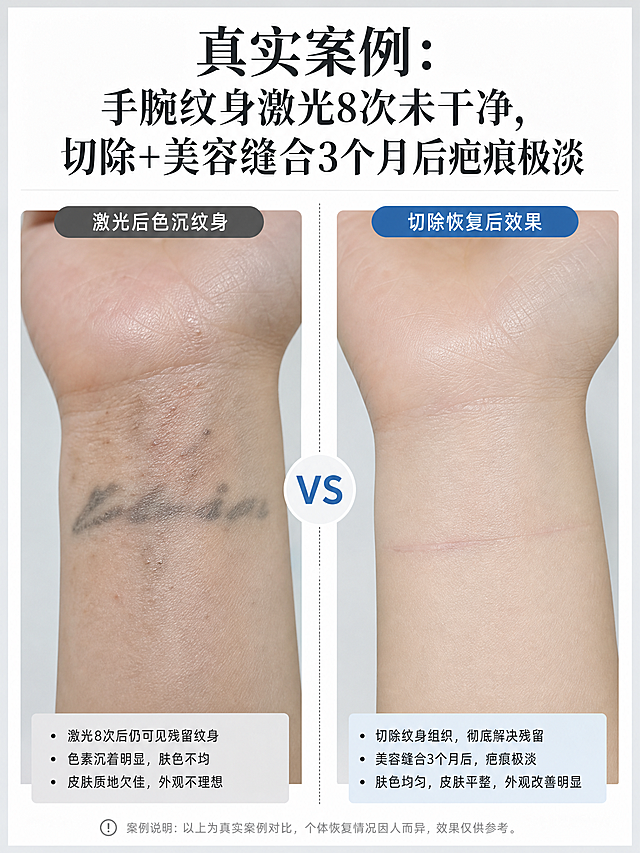 案例对比图，标题：真实案例：手腕纹身激光8次未干净，切除+美容缝合3个月后疤痕极淡，左侧展示激光后色沉纹身，右侧展示切除恢复后效果，对比清晰，医疗科普风，竖版3:4