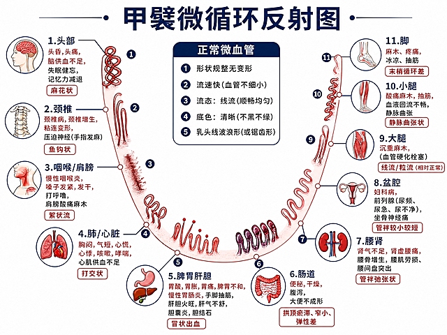 在这张甲襞微循环反射图基础上，为弧形红色血管的11个反射区段分别绘制不同的血管异常形态示意图，每个区段对应一种典型异常，直接在血管弧线上表现出来：

1. 头部区段（最左上）：血管呈现「麻花状、交叉状、袢顶瘀滞」，管袢扭曲缠绕，颜色偏暗红
2. 颈椎区段：血管呈现「管袢纤细较长、鱼钩状」，管袢细长末端弯曲如鱼钩
3. 咽喉/肩膀区段：血管呈现「絮状流」，管袢内血液呈絮状模糊感，轻度红细胞聚集
4. 肺/心脏区段：血管呈现「打交状」，管袢交叉打结形态
5. 脾胃肝胆区段：血管呈现「冒状出血」，袢顶有微小出血点，像冒头一样
6. 肠道区段：血管呈现「袢顶瘀滞、窄小、弹性差」，袢顶膨大瘀滞，颜色深紫
7. 腰肾区段：血管呈现「管袢弛张状」，管袢松弛扩张，管径不均匀
8. 盆腔区段：血管呈现「管袢较小较短」，管袢短小不发达
9. 大腿区段：血管呈现「线流/粒流」，标注为相对正常状态，管袢规整
10. 小腿区段：血管呈现「静脉曲张状」，管袢扩张扭曲
11. 脚区段（最右上）：血管呈现「末梢循环差」，管袢细小稀少，颜色淡

每个异常区段旁边用小标签标注异常名称（如「麻花状」「鱼钩状」「絮状流」「打交状」「冒状出血」等）。中间「正常微血管」说明框保留。整体保持医学科普信息图风格，白色背景，红蓝配色，专业清晰，高分辨率。