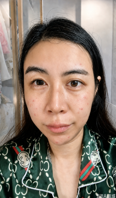 给第一张图模特脸上添加少量第二张图片上的这种红肿痘痘，保留数量不要太多，和原图自然融合，保持整体其他内容不变预览效果